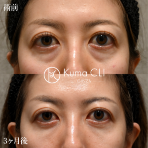 裏evoリフト法＋ナノリッチ